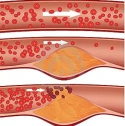 Hogyan lehet megállítani az atherosclerosis