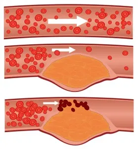 Hogyan lehet megállítani az ateroszklerózis - hasznos cikkek