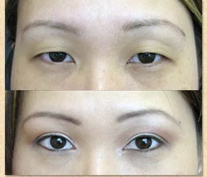 Азиатски блефаропластика око (пластмаса) - Преди & След снимки, цени, коментари