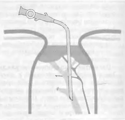 Tratamentul bolii gallstone