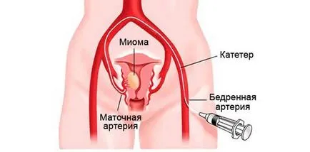 миома на матката лечение - хирургия или народни средства, фото и видео