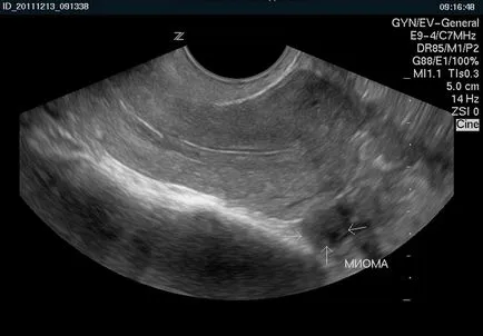 fibrom uterin cât de eficient tratament de atac folk