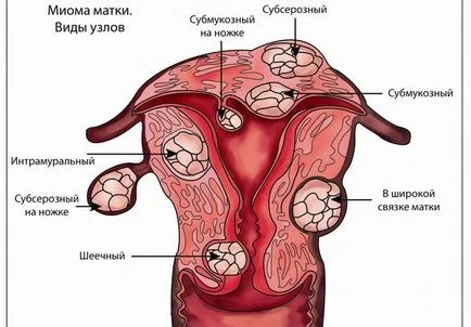 méh mióma kezelése népi jogorvoslat mennyire hatékonyan