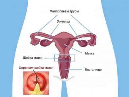 Kezelése nyaki cervicitis gyertyák