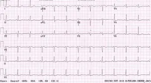 Cum de a descifra cardiograma inimii