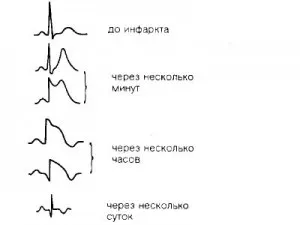 Cum de a descifra cardiograma inimii