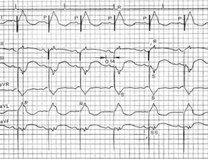 Cum de a descifra cardiograma inimii