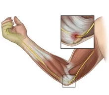 Ulna (alkarcsonti) és radiális alagút szindróma, Dikulja Center