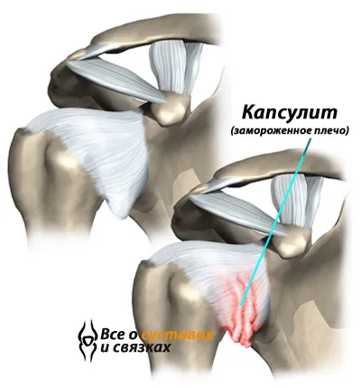 Capsulită simptomelor comune umăr și tratamentul bolii (congelate umăr)