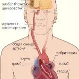 Care sunt cauzele aritmie cardiacă - tratamentul inimii