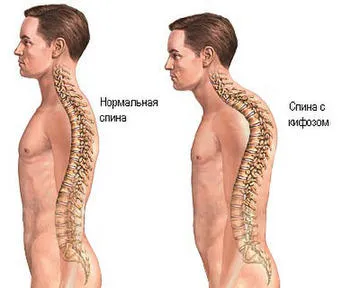 Кифозата на гръбнака на гръдния кош (гръдната кифоза) симптоми, лечение, физикална терапия