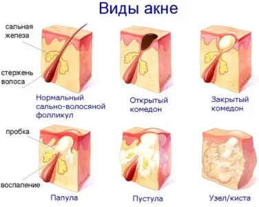 кистозна акне