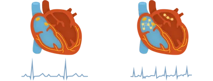 Какви са причините за сърдечна аритмия - лечение на сърцето