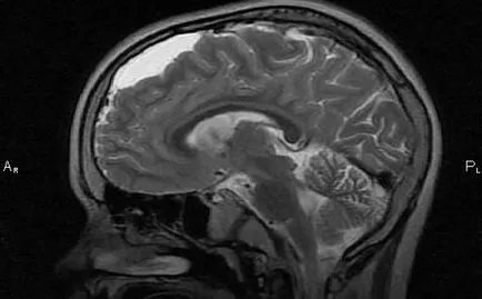 мозъчна киста на клиничните признаци и прогноза