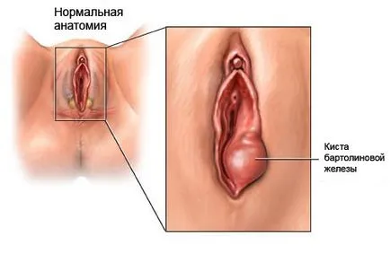 caracteristici anatomice chistul, simptome, diagnostic, tratament