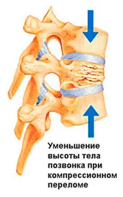 Csigolyacompressióról kezelésére és diagnosztizálására