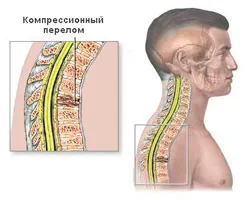 Csigolyacompressióról kezelésére és diagnosztizálására