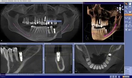 Tomografie computerizata maxilarului, gura, dinti