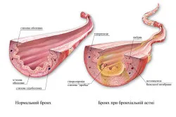 Tratamentul astmului acupunctura