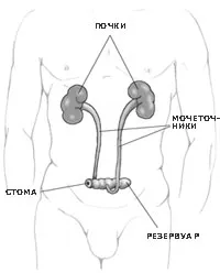 Tratamentul incontinenței urinare la barbati, urolog meu