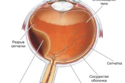 Tratamentul lăcrimare retiniană maculare