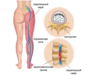 Tratamentul pentru căile de atac sciatica populare la domiciliu