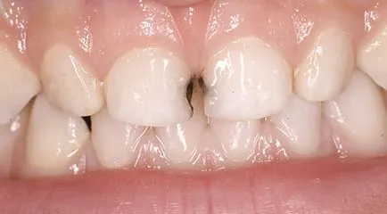Лечение на зъбен кариес при малки деца