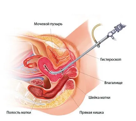 Tratamentul fibromului uterin, fara interventie chirurgicala