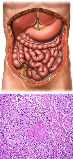 Lipoma hasfal elülső - divatos gyönyörű