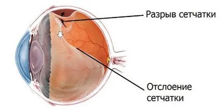 Makula retinaszakadás és a makula degeneráció tünetei és kezelése nedves és az életkor, színpadi,