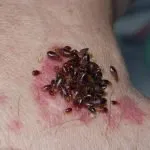 ploșnițe mobilă și căpușe arata ca și cum să scape de insecte