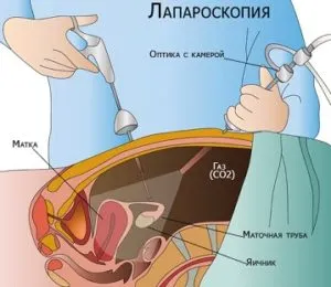 Месечен дали киста на менструация се отразява, когато киста на яйчниците