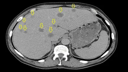 metastaze de melanom in ficat