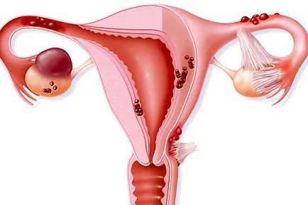 Lunar cu chist ovarian si dupa - cum sunt trebuie să știți