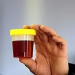 urină închisă la culoare la bărbați