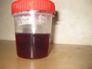 urină închisă la culoare la bărbați