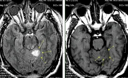 MRI szakértő MRI diagnózisának cerebrovascularis események