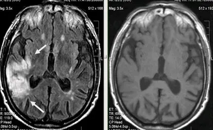 MRI szakértő MRI diagnózisának cerebrovascularis események