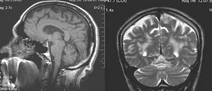 MRI szakértő MRI diagnózisának cerebrovascularis események