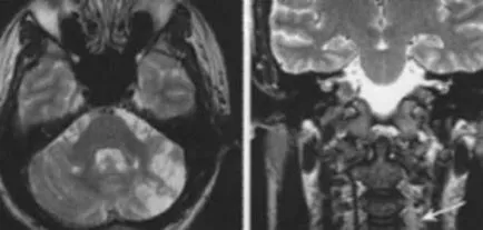 MRI szakértő MRI diagnózisának cerebrovascularis események