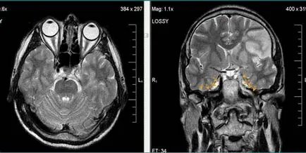 MRI експерт MRI при диагностицирането на мозъчно-съдови събития