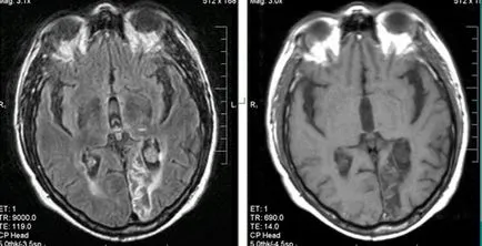 MRI szakértő MRI diagnózisának cerebrovascularis események