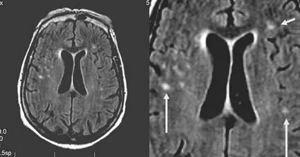 MRI szakértő MRI diagnózisának cerebrovascularis események