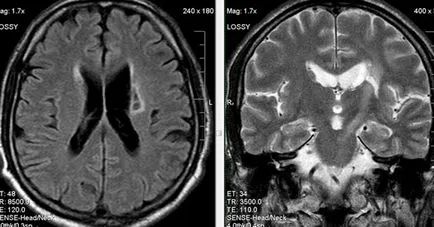 MRI szakértő MRI diagnózisának cerebrovascularis események