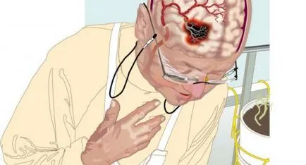 RMN-ul in tipuri de accident vascular cerebral, care va studia