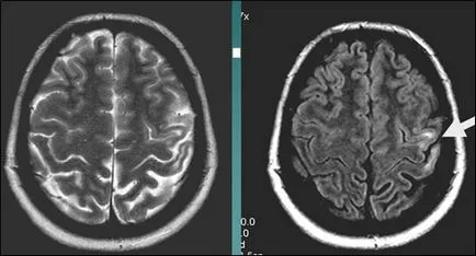 MRI szakértő MRI diagnózisának cerebrovascularis események