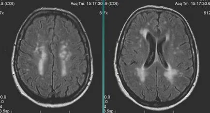 MRI szakértő MRI diagnózisának cerebrovascularis események