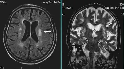 MRI експерт MRI при диагностицирането на мозъчно-съдови събития