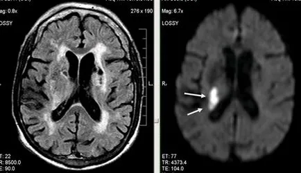 MRI szakértő MRI diagnózisának cerebrovascularis események