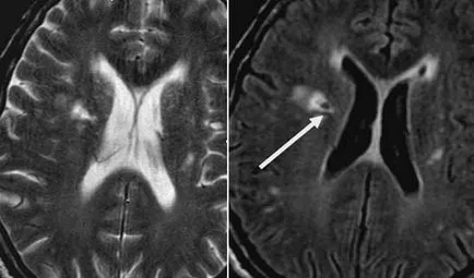 MRI szakértő MRI diagnózisának cerebrovascularis események